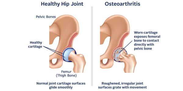 osteophytes hip